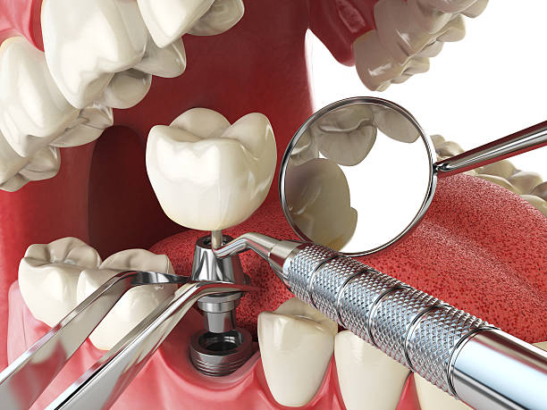 Best Emergency Dental Care for Broken or Chipped Teeth in Burnsville, NC